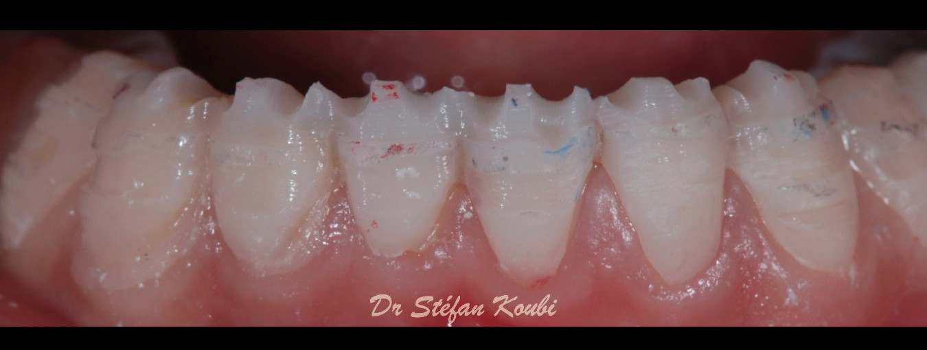 veneers and crowns /Dr Stefan Koubi